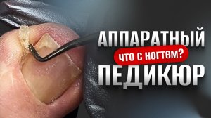 ХИРУРГ ИЗУРОДОВАЛ НОГОТЬ😱