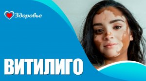 Здоровье. Витилиго