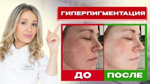 Гиперпигментация как не допустить её появление летом