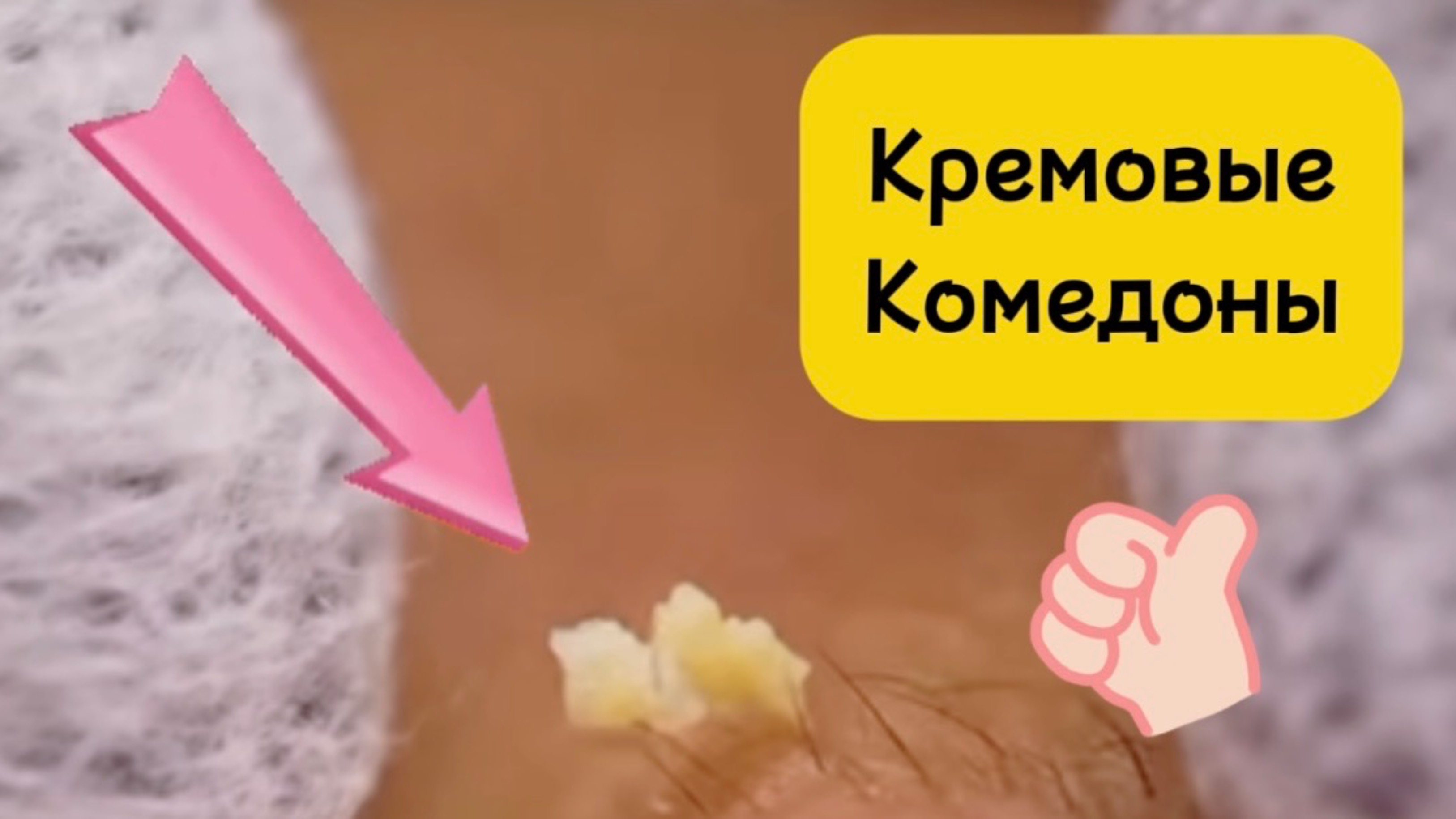 Очистка лица от угрей и акне.
Выдавливание прыщей. Удаление черных точек и комедонов.