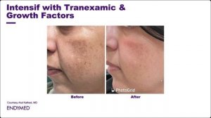 Новые протоколы лечения Мелазмы и Розацеа на платформе Endymed