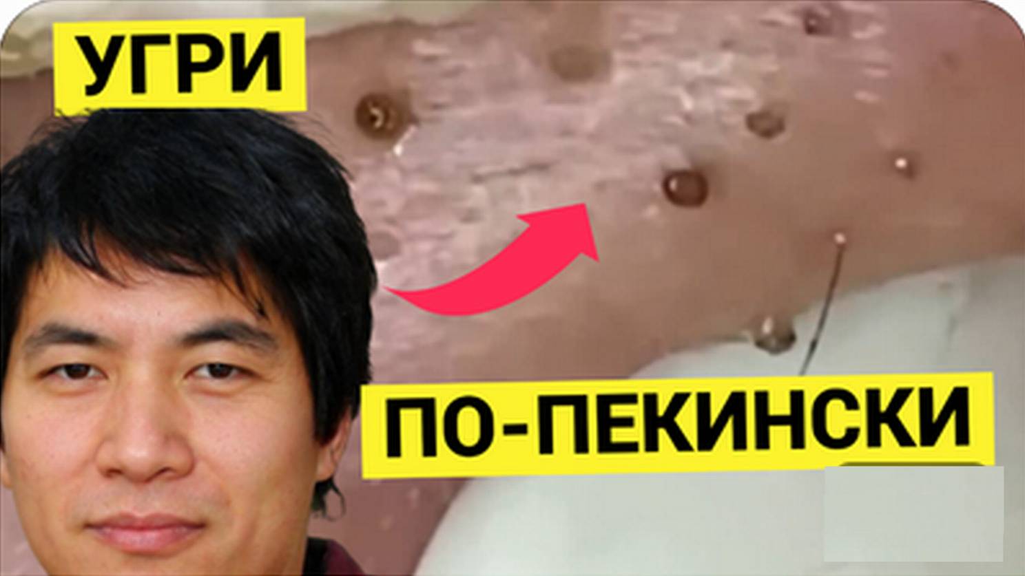 Безответственное Выдавливание Прыщей и Жировиков с Угрями, но уж очень Весёлое и Динамичное. Космето