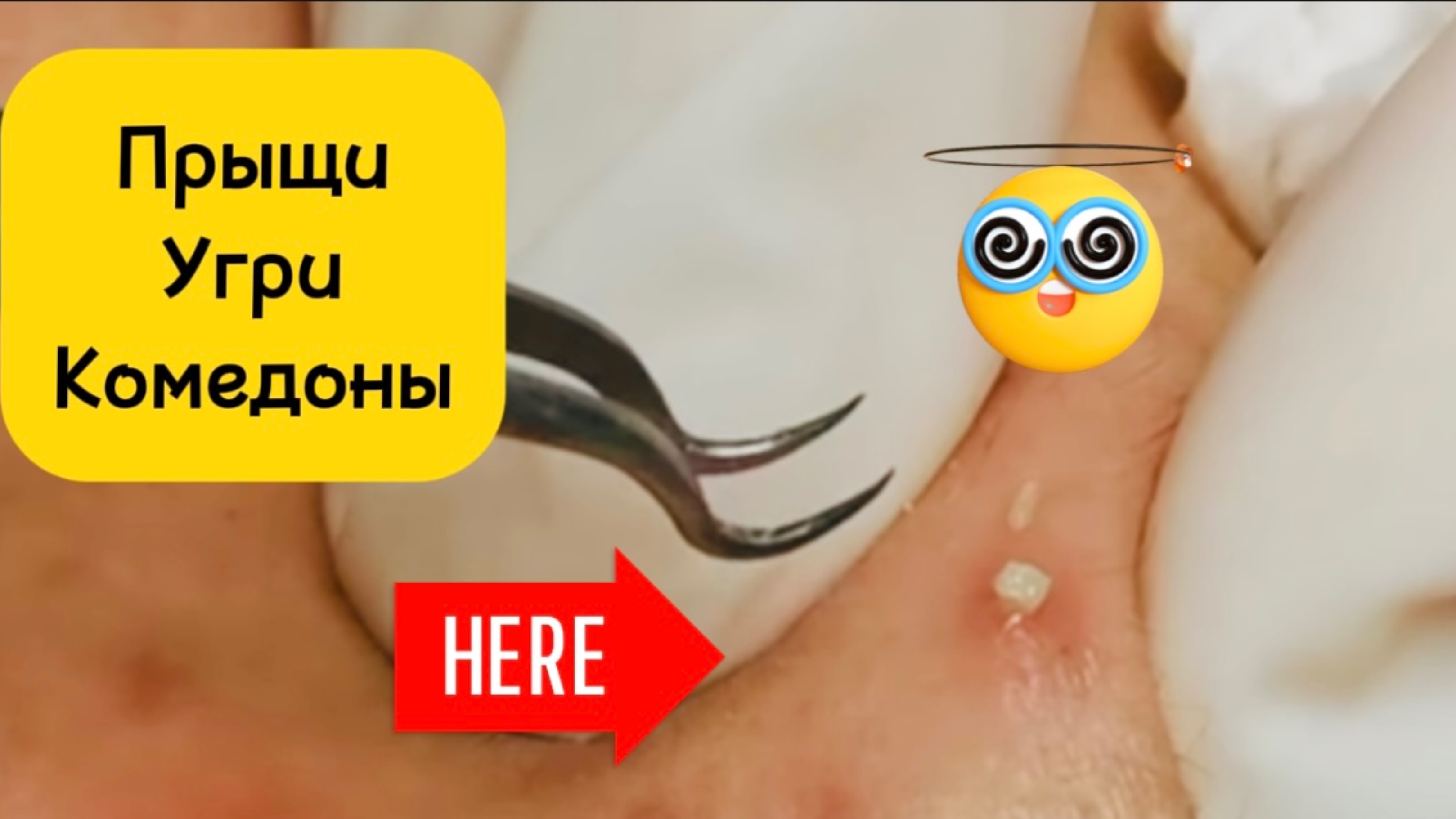 Очистка лица от угрей и акне.
Выдавливание прыщей. Удаление черных точек и комедонов.