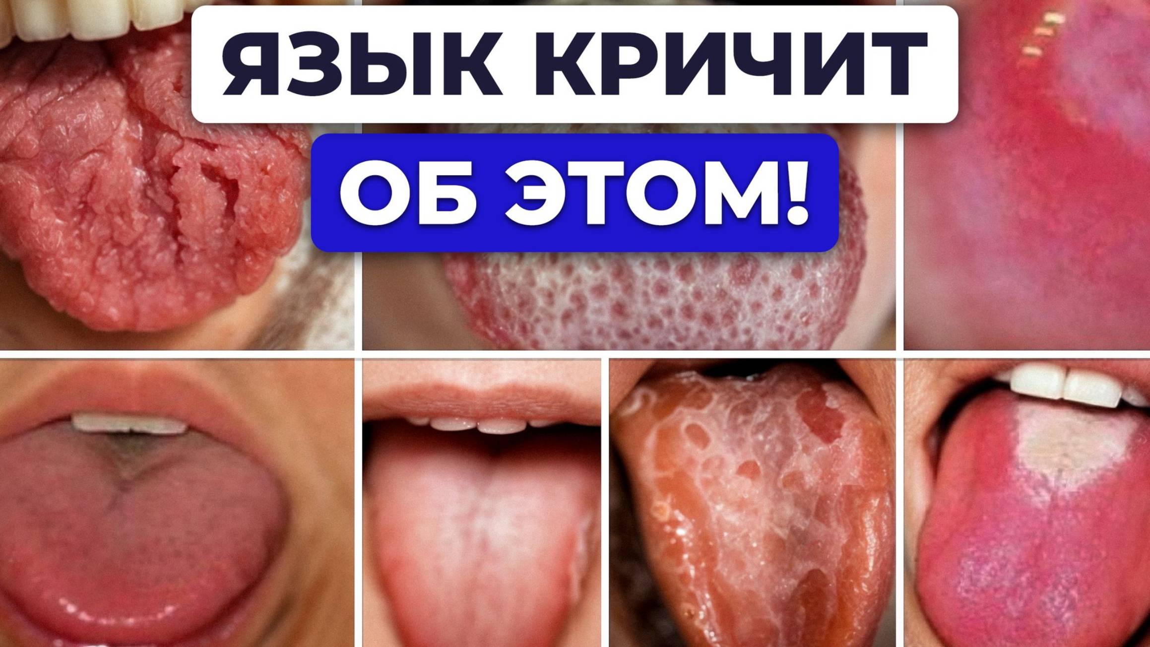 НЕ ПРОПУСТИ эти СТРАШНЫЕ заболевания, о которых предупреждает ЯЗЫК / Как провести самодиагностику?