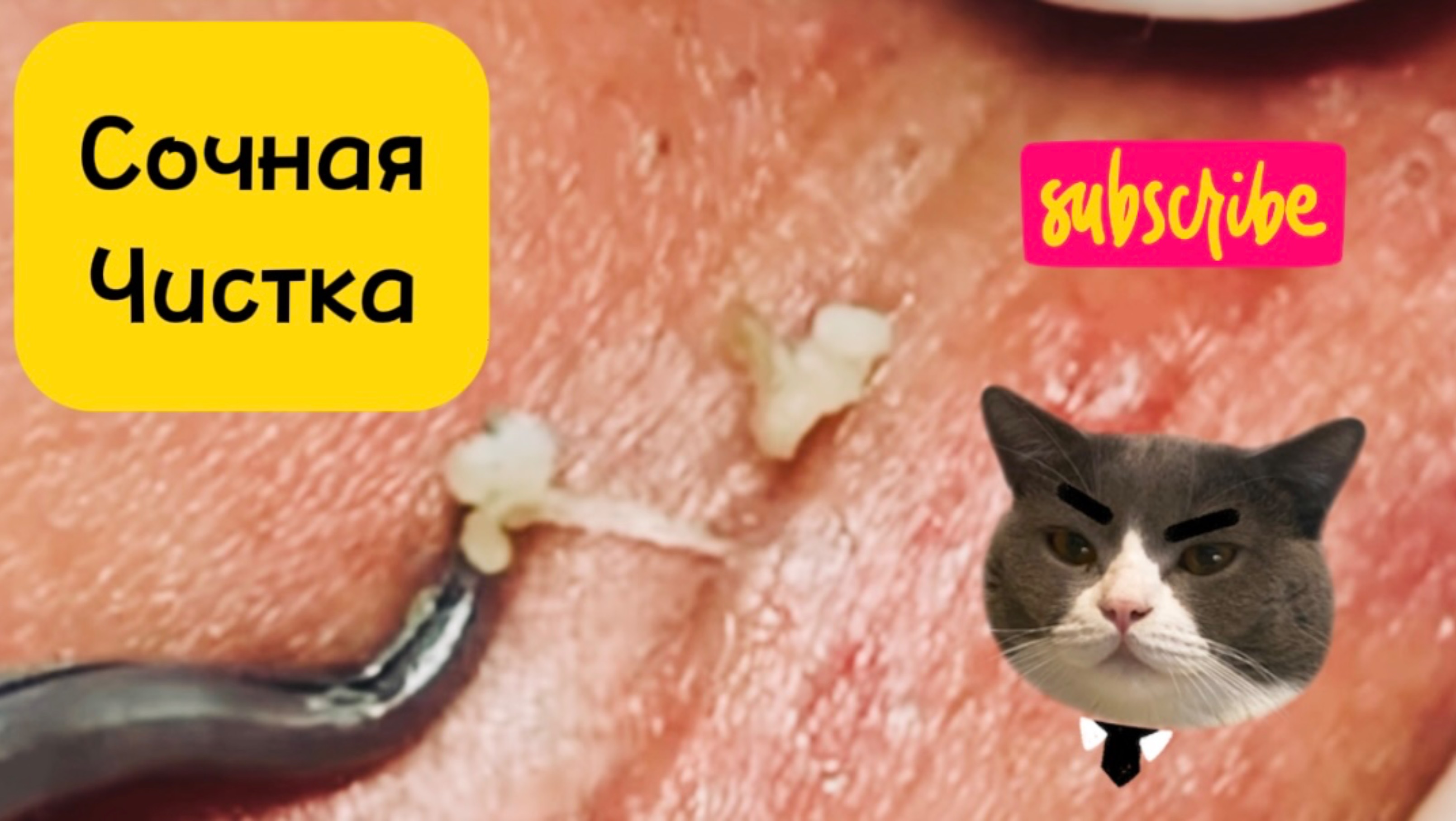 Очистка лица от угрей и акне.
Выдавливание прыщей. Удаление черных точек и комедонов.