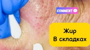 Очистка лица от угрей и акне.
Выдавливание прыщей. Удаление черных точек и комедонов