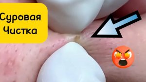 Суровая чистка.Очистка лица от угрей и акне.
Выдавливание прыщей. Удаление черных точек и комедонов