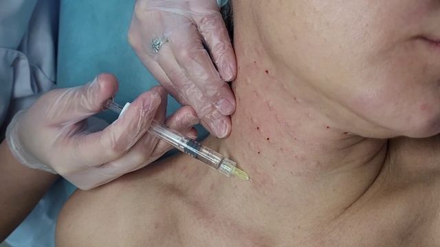 Биоревитализация кожи декольте и шеи.Влас