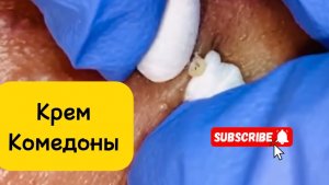 Очистка лица от угрей и акне.
Выдавливание прыщей. Удаление черных точек и комедонов