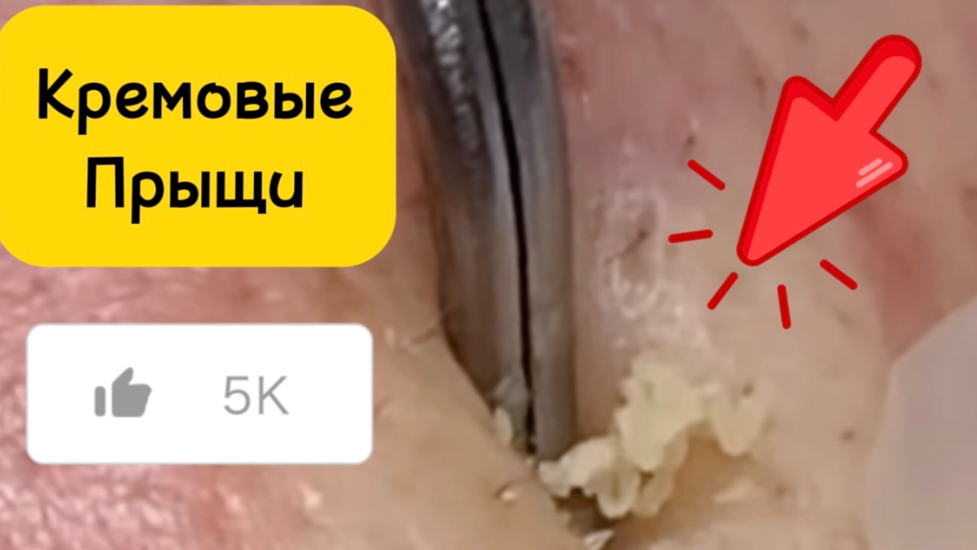 Кремовые ПРЫЩИ. Очистка лица от угрей и акне.
Выдавливание прыщей. Удаление черных точек и комедонов