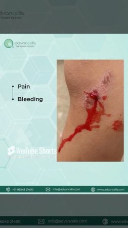 Symptoms of Skin Abrasions | #Advancells #StemCellTherapy