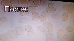 Кровь под микроскопом до и после нашего прибора