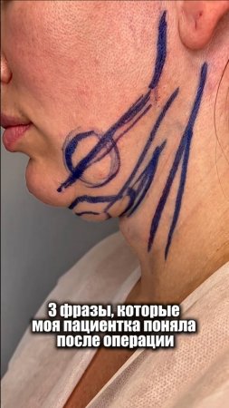 Вот что поняла пациентка после липосакции подбородка!