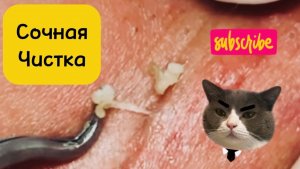 Сочная чистка. Очистка лица от угрей и акне.Выдавливание прыщей. Удаление черных точек и комедонов.