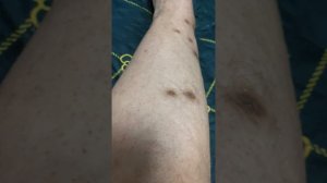 Перелом ноги