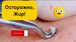 Очистка лица от угрей и акне. Выдавливание прыщей. Удаление черных точек и комедонов.