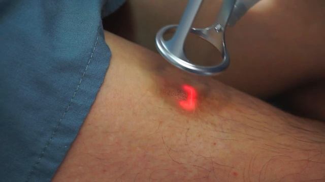 Лазерное Удаление Шрама На Ноге смотреть онлайн