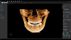 MEC ‑ Auto Nerve line & root canals