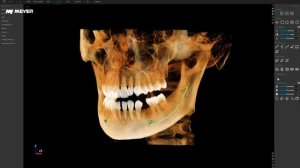 MEC ‑ Auto Maxillary Sinus