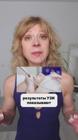 Носогубки ушли без ФИЛЛЕРОВ!