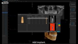MEC ‑ Automatic  Implant Simulation