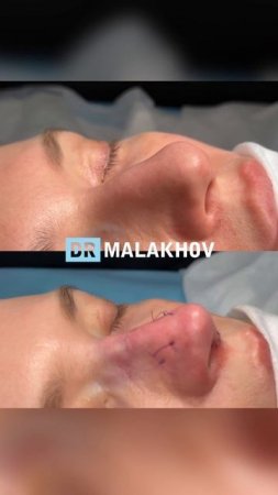 Первичная риносептопластика + ментопластика 💡