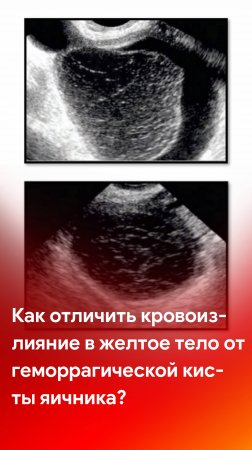 УЗИ в гинекологии: как отличить кровоизлияние в желтое тело от геморрагической кисты яичника?