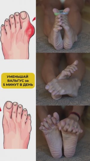 Уменьшаем вальгус за 5 минут. Подпишись и читай описание ✅