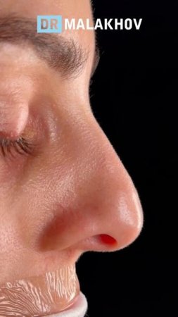 Первичная риносептопластика 👃🏼
ДО и НА ОПЕРАЦИОННОМ столе