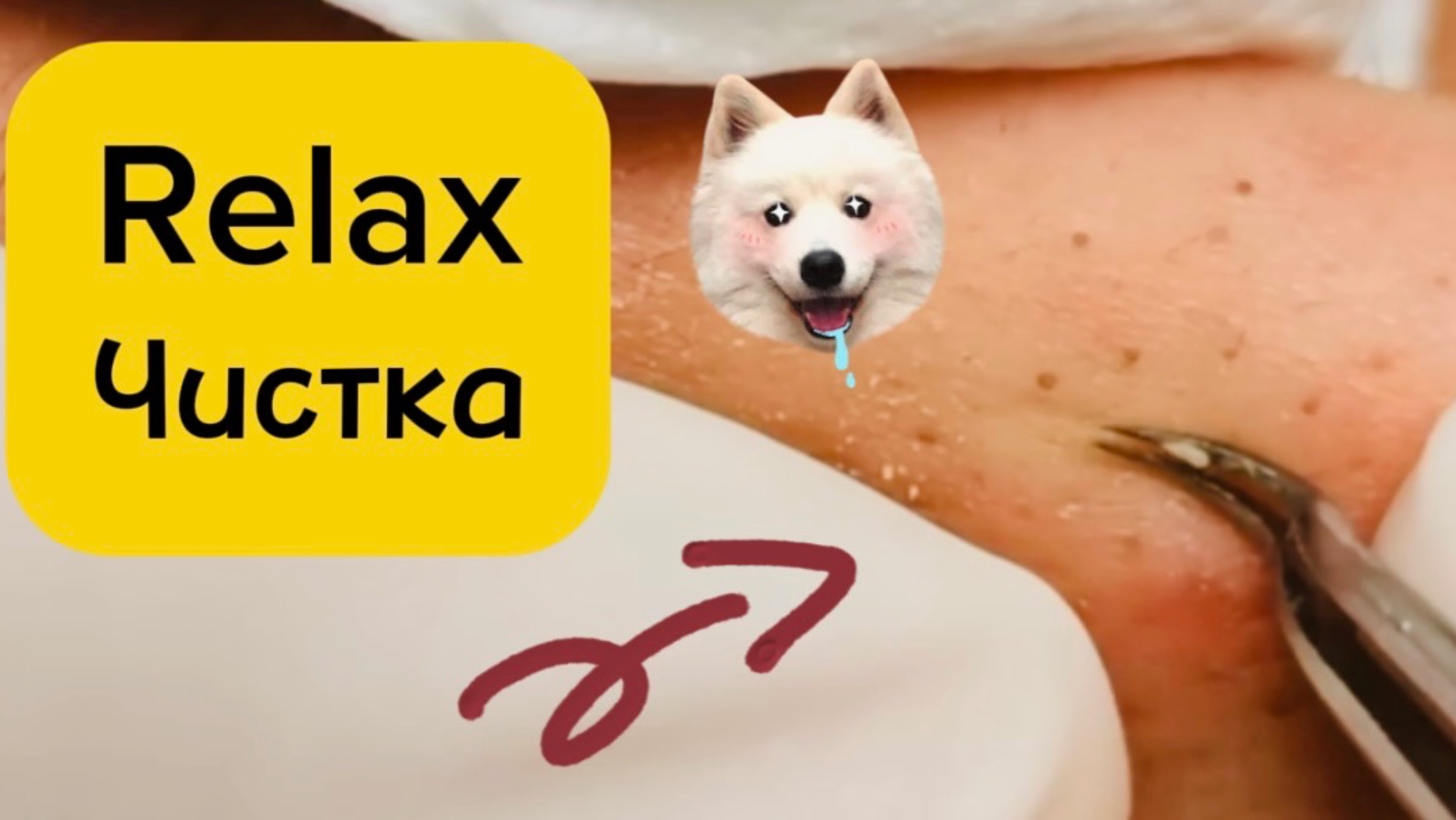 Чистка лица от угрей и акне. Выдавливание прыщей. Удаление черных точек и комедонов.