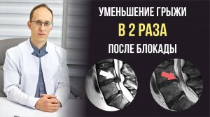 Влияние блокад на процесс уменьшения грыж позвоночника