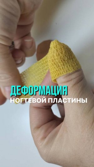 Деформация ногтевой пластины