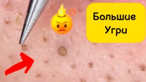 Чистка лица от угрей и акне. Выдавливание прыщей. Удаление черных точек и комедонов