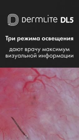 DermLite DL5 — 3 режима освещения для точной диагностики