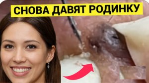 Снова Выдавливают ВОКРУГ РОДИНКИ Жировики и Комедоны. Безопасно ли Это, Давайте Узнаем