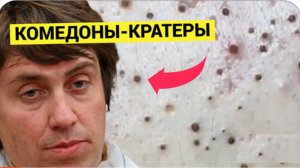 Прыщи и Комедоны как КРАТЕРЫ на Луне. Уникальный Гость. Попал в хорошие руки КОСМетолога. Выдавил вс