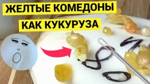 Желтые как КУКУРУЗА Комедоны и Жировики Пришлось Выдавливать Мастеру не без Труда. Зачем так тянула
