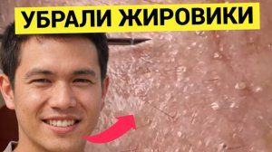 Выдавливание Прыщей и Жировиков После Хозяйственного Мыла