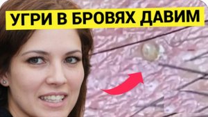 Много Комедонов в Бровях РАСПЛОДИЛОСЬ и на Висках. Косметолог как Грибник, собирает Урожай чётко, хо