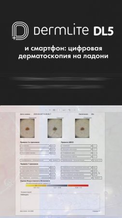 DermLite DL5 + смартфон = цифровая дерматоскопия «на ладони»