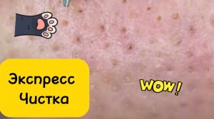 Чистка лица от угрей и акне. Выдавливание прыщей. Удаление черных точек и комедонов.
