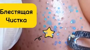 Чистка лица от угрей и акне. Выдавливание прыщей. Удаление черных точек и комедонов.