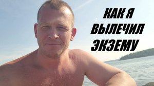 Как я вылечил сильную многолетнюю Экзему (диатез, дерматит, кожную аллергию)