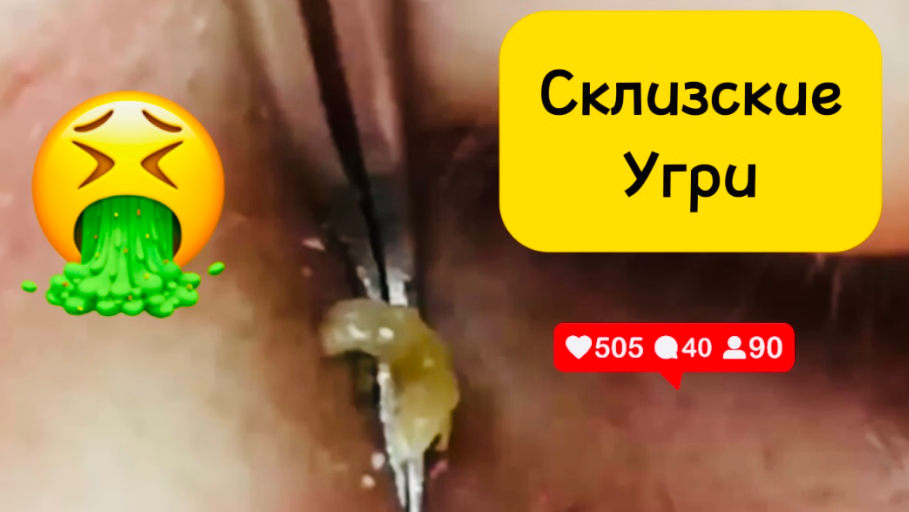 Чистка лица от угрей и акне. Выдавливание прыщей. Удаление черных точек и комедонов.