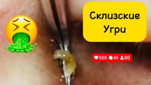 Чистка лица от угрей и акне. Выдавливание прыщей. Удаление черных точек и комедонов.