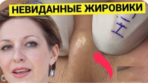Смачные ЖИРОВИКИ и Сальные Комедоны Как на Заказ Принёс Гость Косметологу. Зачем только было Размазы