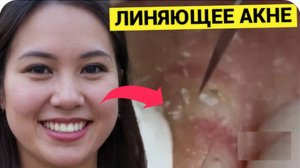 Толстокожий ЛИНЯЮЩИЙ Гость, Прилёг Почиститься от Прыщей и Комедонов