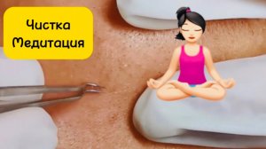 Чистка лица от угрей и акне. Выдавливание прыщей. Удаление черных точек и комедонов.