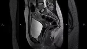 МРТ органов малого таза