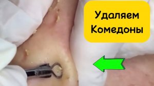 Чистка лица от угрей и акне. Выдавливание прыщей. Удаление черных точек и комедонов.